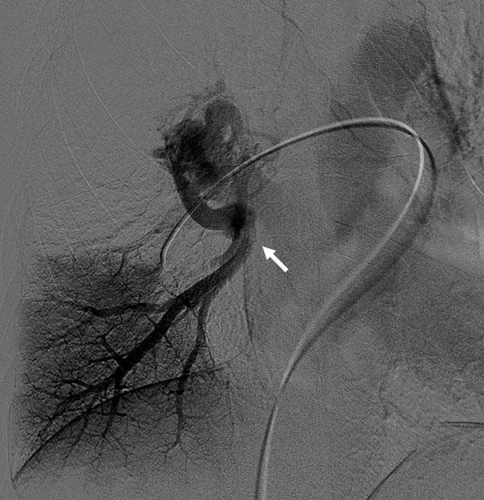 case, a case described as isolated pulmonary vein stenosis associated with full compensation of intrapulmonary venous drainage was reported by Saida (10).