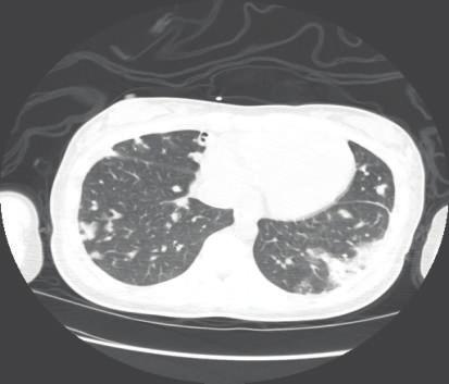 onday11,thepatientbecamefebrileandchest X-ray showed diffuse airspace disease and cavitary lesions (Figure 5).