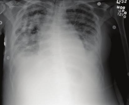 Figure 4: Chest tomography showing development of pulmonary infiltrates. 3.