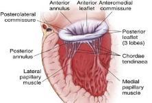 Background The Mitral Valve Open heart surgery became possible in the second half of the 20 th Century.
