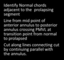 chords adjacent to the prolapsing segment