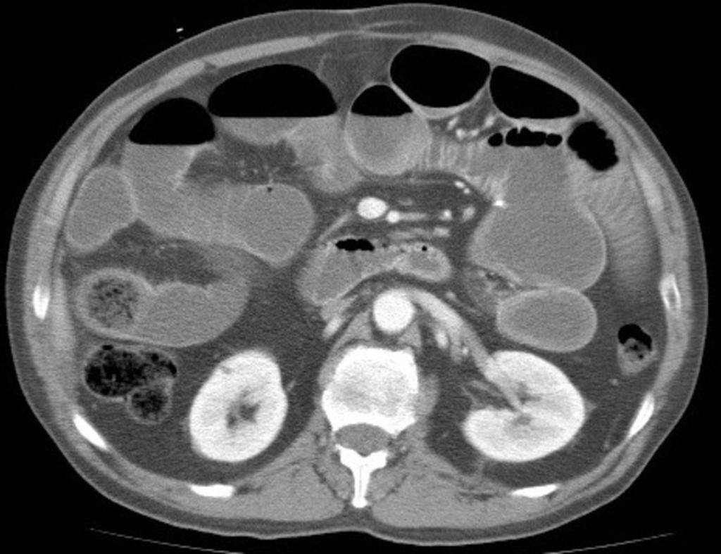 Fig. 4: 59 year-old woman with a small-bowel obstruction due to a bezoar.