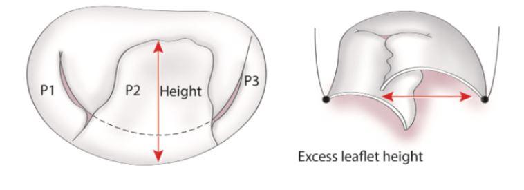 How to deal with Excess height Techniques Resection : reduces height Pulling free edge downwards (Gore tex