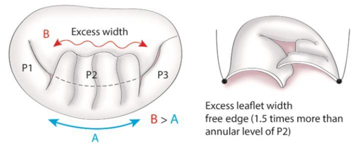 How to deal with Excess width Techniques Triangular resection Ignore it