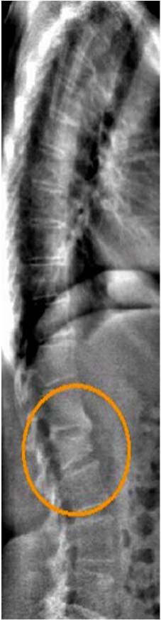 Proactive targeted screening spine imaging recommended to identify those with spine