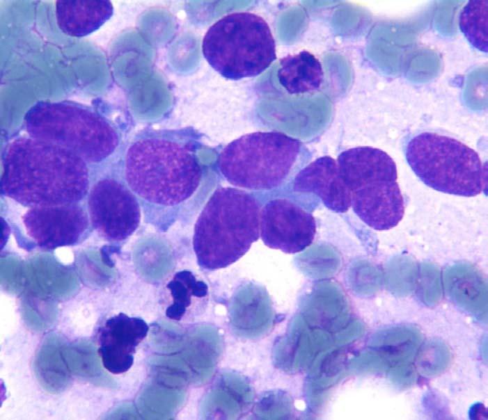 Poorly Differentiated Carcinoma Image 9: Small cell undifferentiated carcinoma will