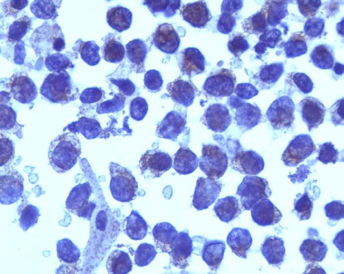 Poorly Differentiated Carcinoma A B Image 10: Synaptophysin