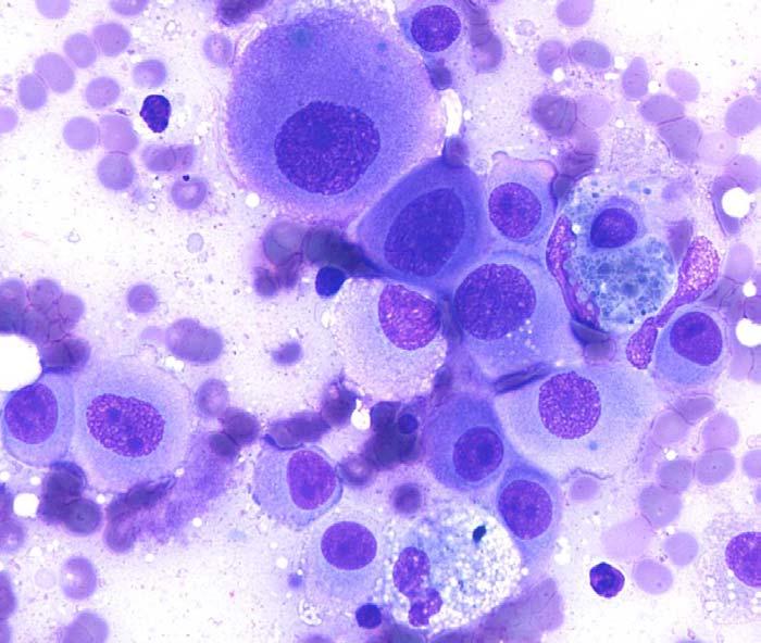Melanoma Image 11: Romanowsky Stained smear, 50x. Notice how large the cells are and their abundant cytoplasm.