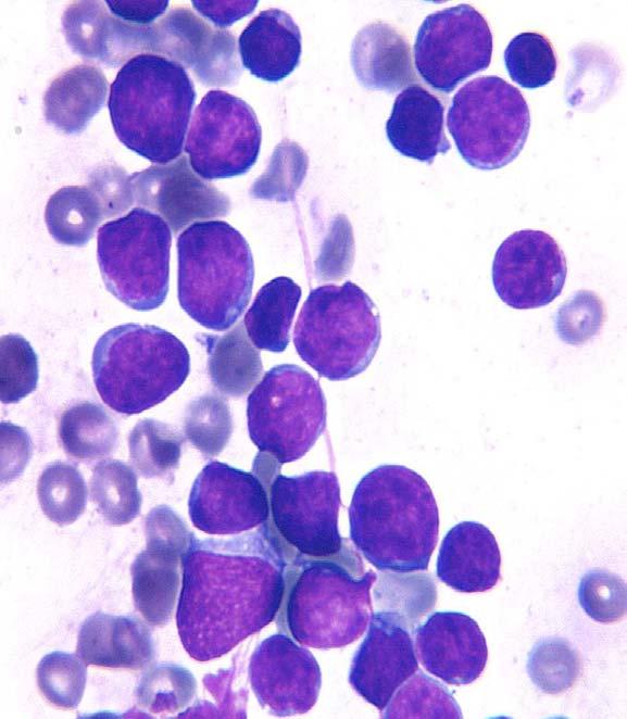 Lymphoblastic Lymphoma Image 19: The lymphocytes of lymphoblastic lymphoma are