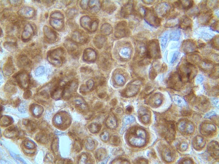 Peripheral T cell Lymphoma, NOS Image 23 : CD3 is strongly positive in the malignant