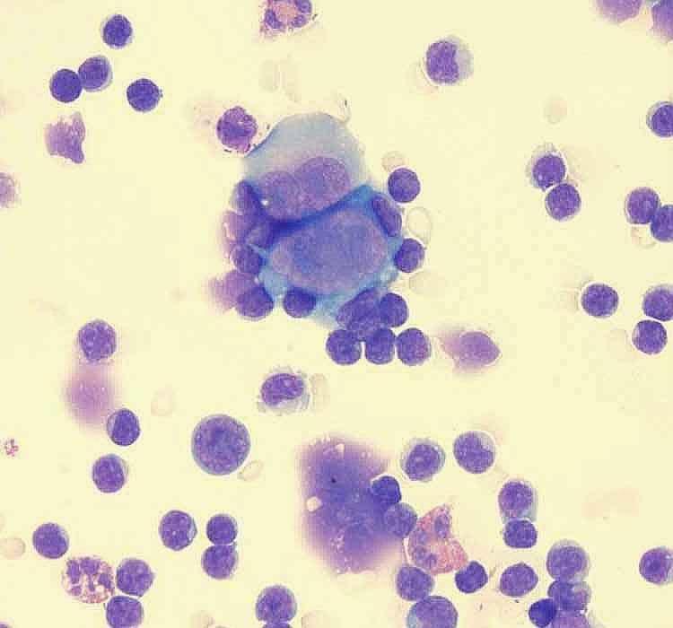 Hodgkin's Lymphoma Although Hodgkin s lymphoma is not high on the differential diagnosis of Large Cell Lymphoma, it may be a consideration when entertaining the diagnosis of ALCL.