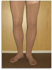 months) Compression stockings to reduce swelling Comerota