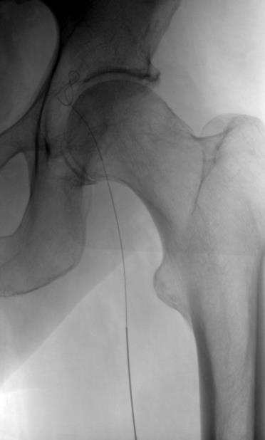 Ipsilateral Mid-femoral Access The tip of the inserted