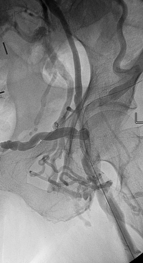 Identifying Lesion and RVD - PTS Occlusion