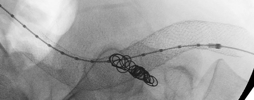 mm stent Images