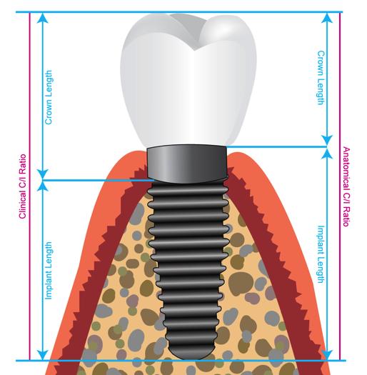 of fulcrum differentiates between an anatomical crown:implant