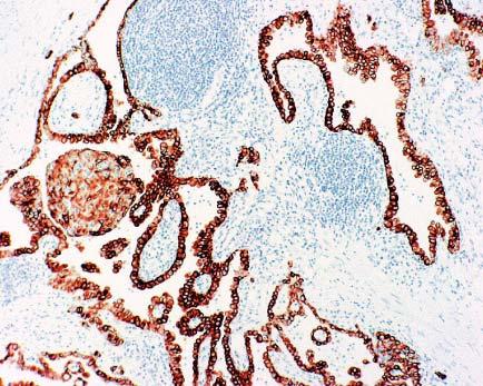 Malignant mesothelioma cells