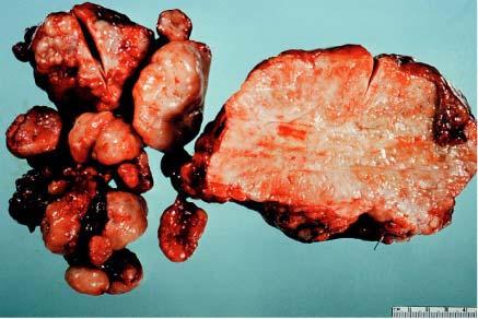 Gross appearance of desmoplastic small cell tumor.