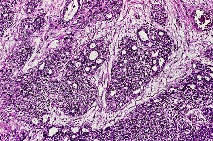 Desmoplastic small cell tumor showing glandular