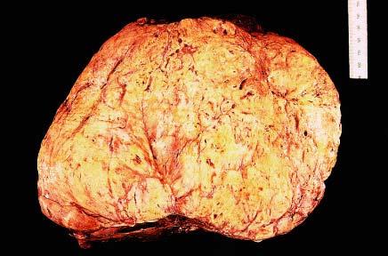 Gross appearance of solitary fibrous tumor