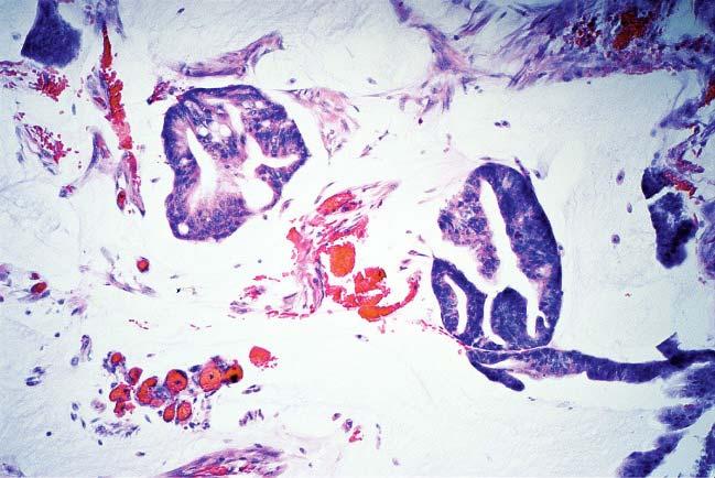 Microscopic appearance of pseudomyxoma peritonei.