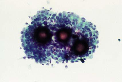 Positive peritoneal cytology in a patient with serous