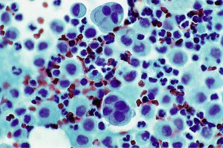 Positive peritoneal cytology in a