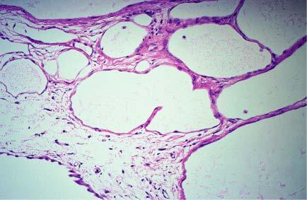 So-called multicystic benign mesothelioma. B, Microscopic appearance.