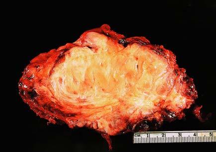 Fibromatosis of mesentery involving the bowel wall.