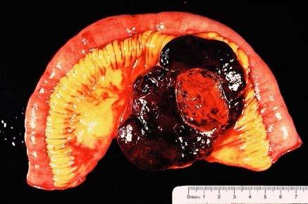 Gross appearance of paraganglioma of the mesentery.