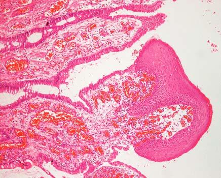 Umbilical polyp partially lined by glandular