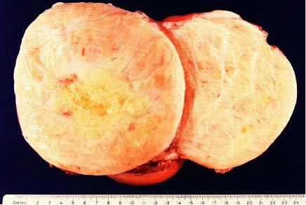 Cut surface of well-differentiated liposarcoma