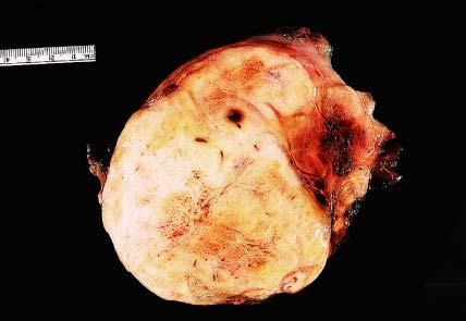 Gross appearance of retroperitoneal well-differentiated liposarcoma (atypical