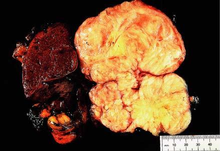 Gross appearance of retroperitoneal leiomyosarcoma, removed in continuity
