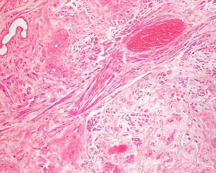 Retroperitoneal smooth muscle tumor in pelvic region