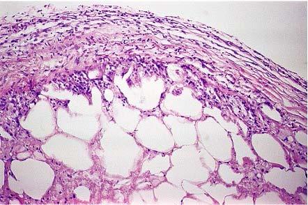 Twisted appendix epiploica.