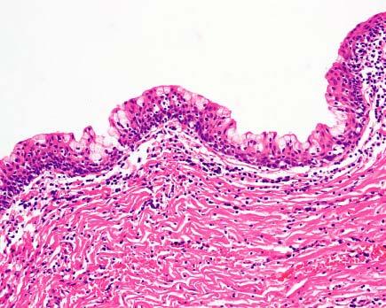 Tailgut cyst lined by mucin-secreting