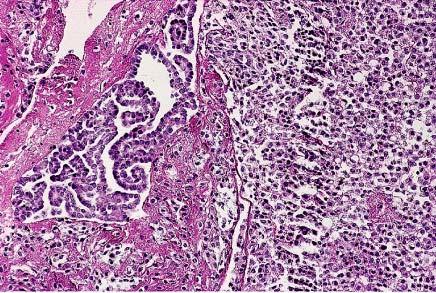 A and B, Florid mesothelial hyperplasia in hernia sac.