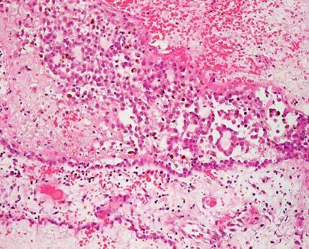 Reactive mesothelial hyperplasia in a patient with granulosa cell