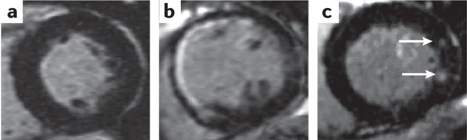 Figure 2 Several patterns of LGE-CMR can be observed in