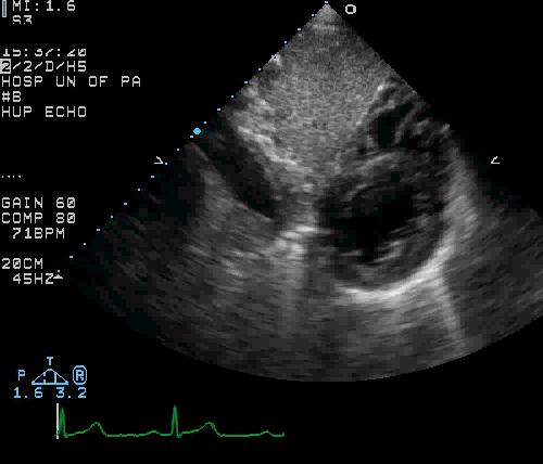 Question 2 Which myocardial segment is denoted by the arrow? A. Mid Anterior B.