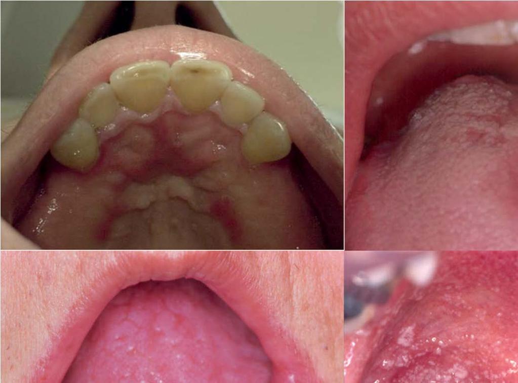 A single-center 18-year experience with oral candidiasis in Brazil: a retrospective study of 1,534 cases Table 2. Profile of 1,534 patients seen at the CDOD in Southern Brazil (Pelotas, 1997 2014).