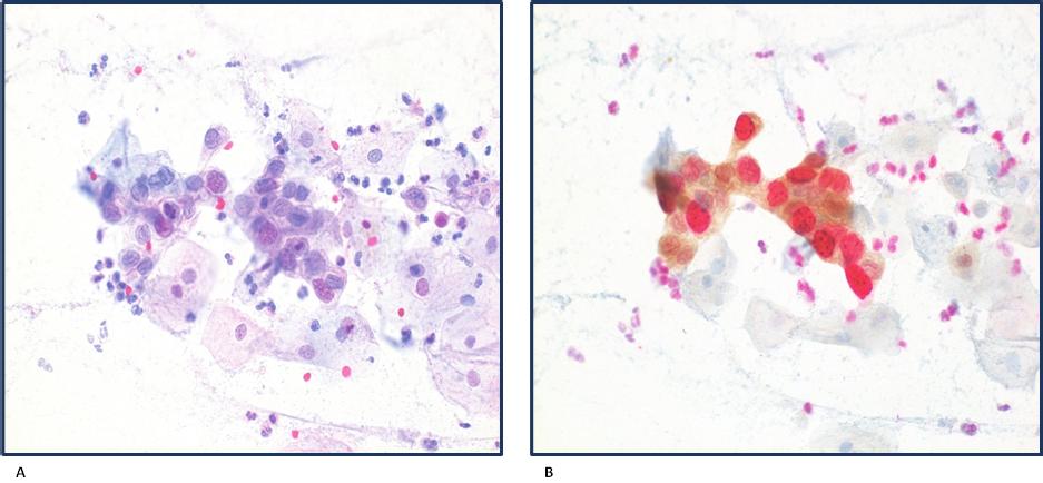 p16/ki-67 dual-stained cytology in BMD Pap cytology 35 In the sub-study reported here, we selected all archived conventional cytology slides of the 337 women with BMD participating in the