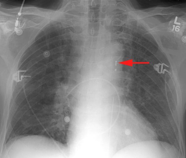 The catheter should be in the region of the aortic isthmus or left main
