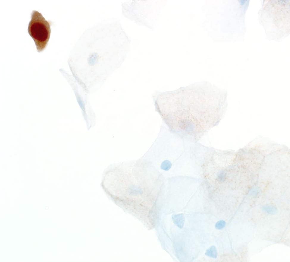 with intense, dark p16 staining, positive for CINtec