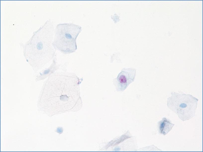 Figures 2.2: Examples of CINtec PLUS Cytology negative cells stained with p16 or Ki-67 No dual-stained cells are present in the following images.