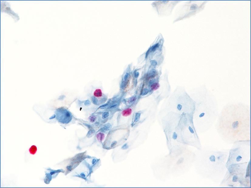 Figures 2.2, continued: Examples of CINtec PLUS Cytology negative cells stained with p16 or Ki-67 No dual-stained cells are present in the following images.