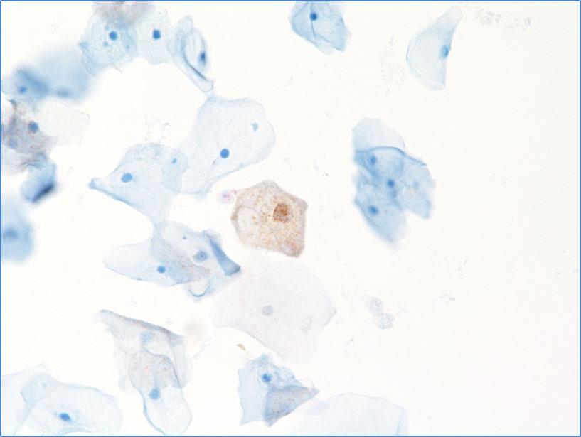 Figures 2.2 continued: Examples of CINtec PLUS Cytology negative cells stained with p16 or Ki-67 No dual-stained cells are present in the following images.