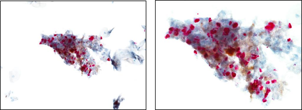 Figures 2.3: Examples of p16 and Ki-67 staining in cell clusters Each description follows the CINtec PLUS Cytology cell cluster interpretation algorithm to evaluate the staining results.