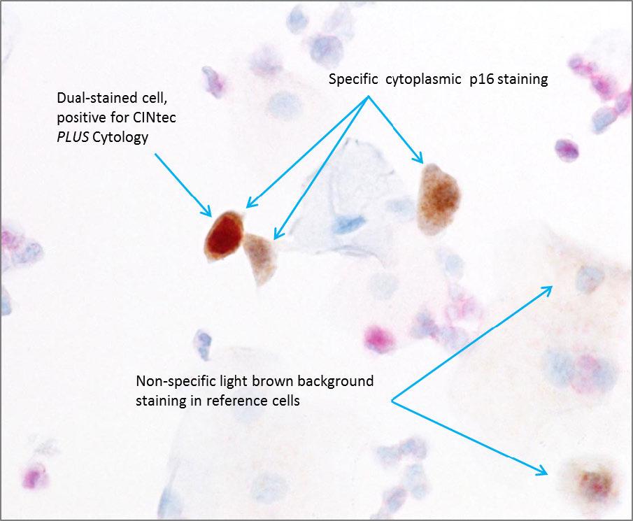 the non-specific cytoplasmic brown background staining in the reference cells.